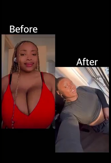 Breast Reduction Results After Surgery